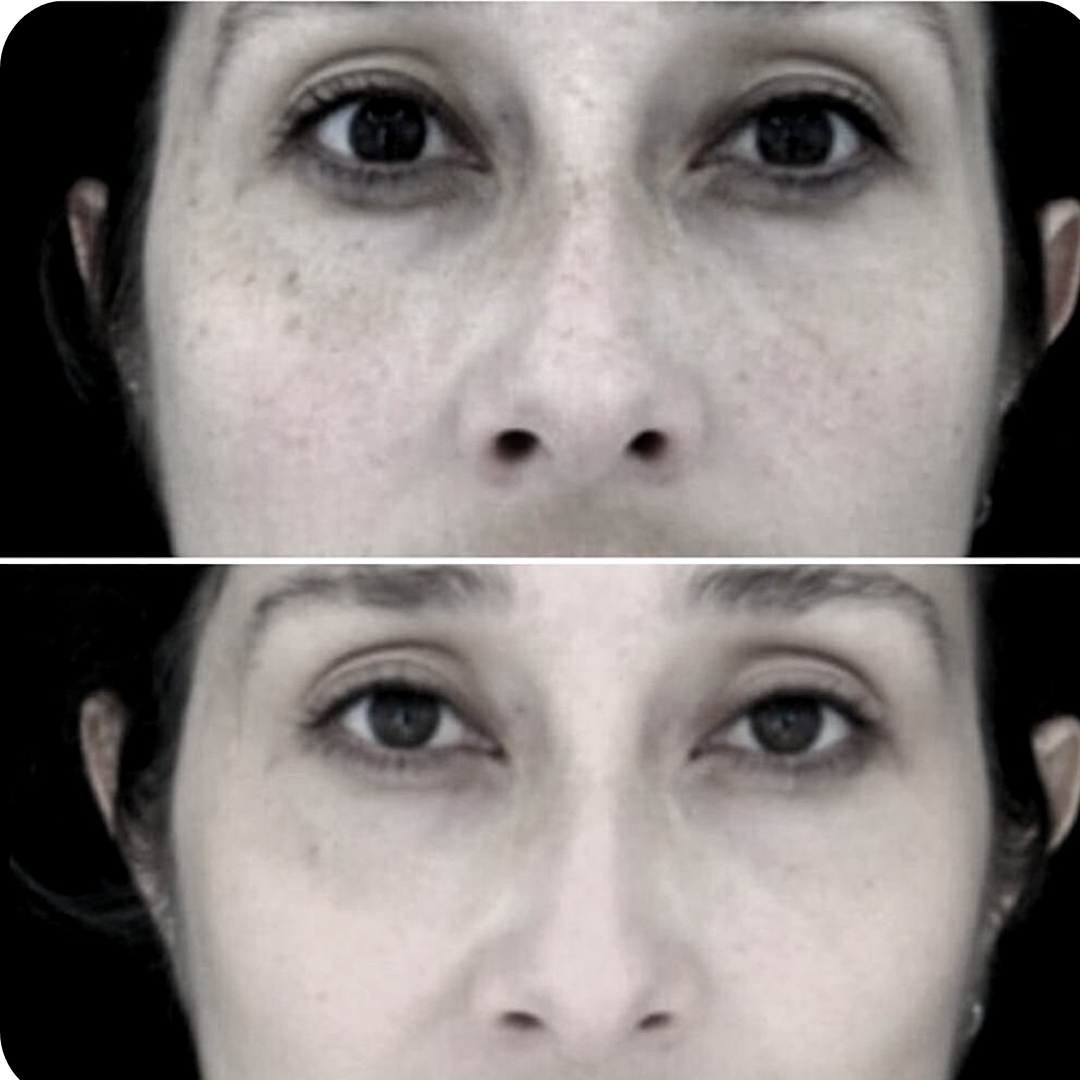 Fotorejuvenecimiento facial (1 sesión)