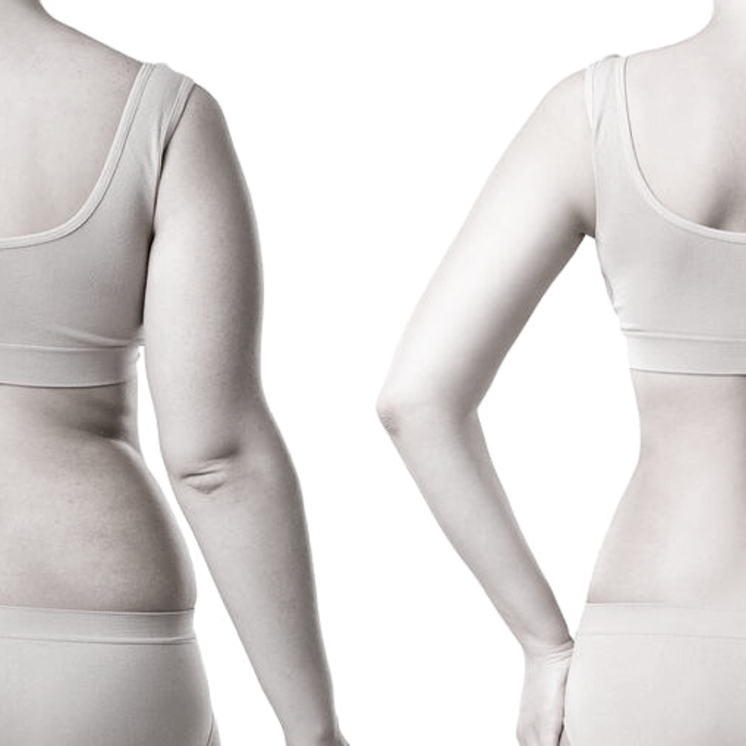 Accent Corporal (Abdomen) 10 sesiones